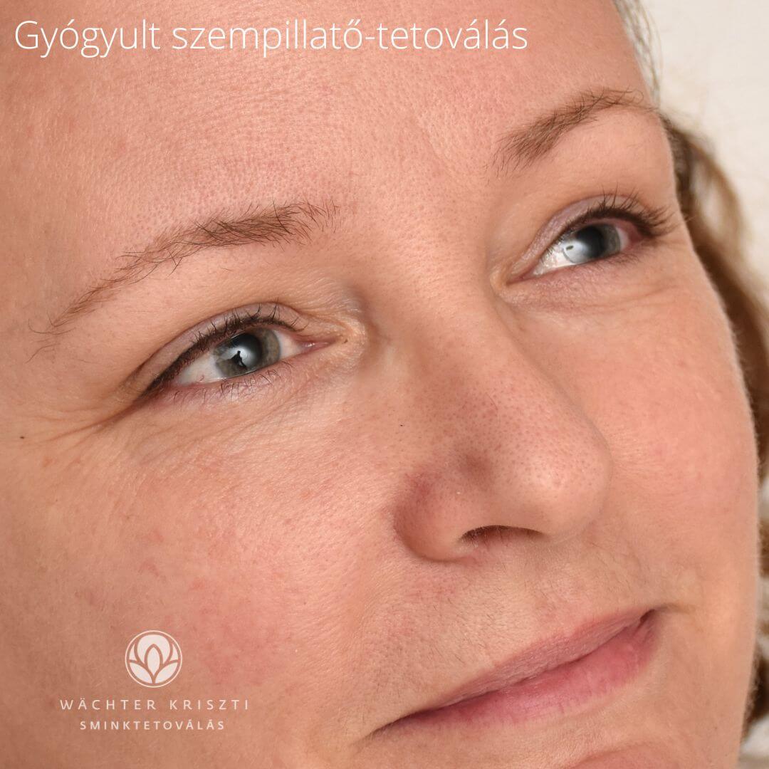 Gyógyult szempilla-tosűrítés